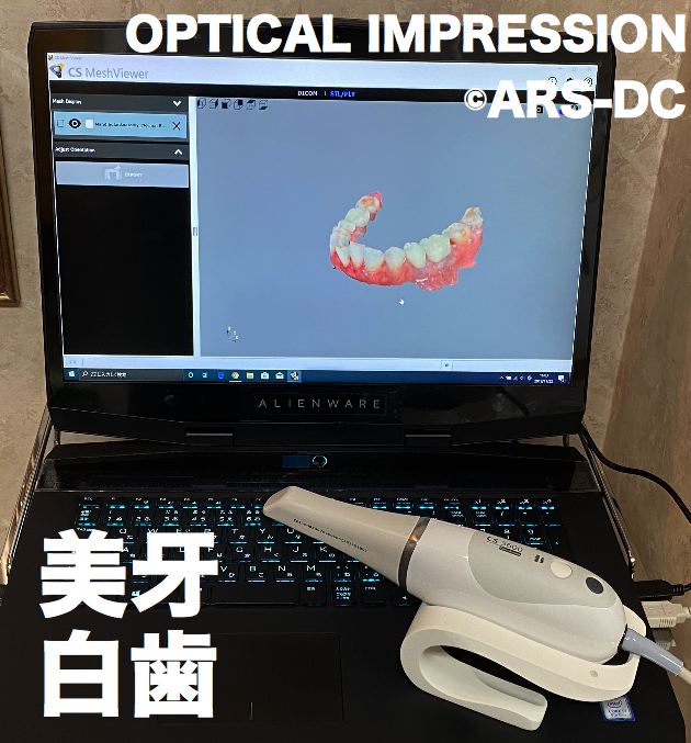 光学印象始動!!　ゴムの型取りをしなくても良い口腔内スキャナー開始